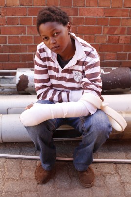 The wounded activist at Con Hill where she attended JhP People's Pride launch on the 17th Aug. 2013. Photo by Thekwane Bongi Mpisholo